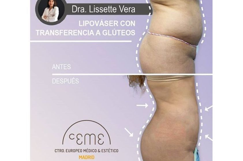 Lipo Vaser antes y después - 702154