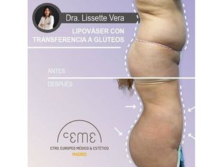 Antes y después Lipo vaser - Centro CEME