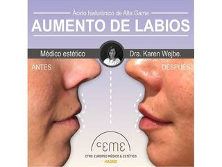 Antes y después Aumento de labios - Centro CEME