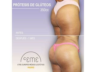 Antes y después Aumento de glúteos - Centro CEME