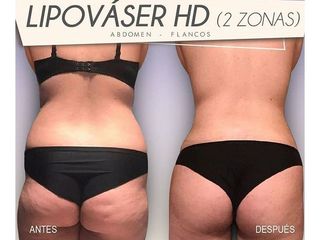Antes y después Lipo vaser - Centro CEME