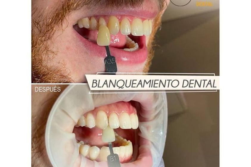 Blanqueamiento dental antes y después - 702160