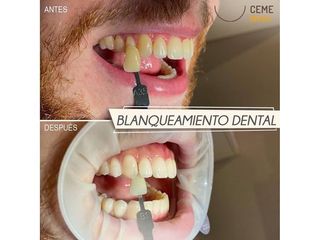 Antes y después Blanqueamiento dental - Centro CEME