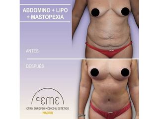 Antes y después Abdominoplastia - Centro CEME