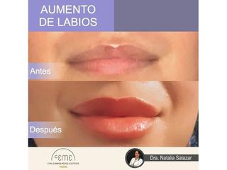 Antes y después Aumento de labios - Centro CEME
