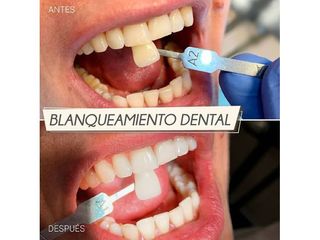 Blanqueamiento dental - Centro CEME