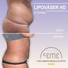 Lipo vaser - Centro CEME