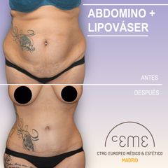 Abdominoplastia - Centro CEME