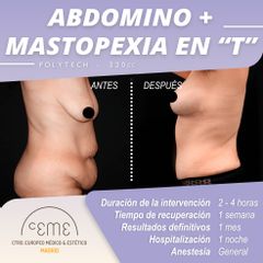 Abdomino + Mastopexia - Centro CEME