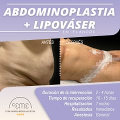 Abdominoplastia + Lipo Váser - Centro CEME