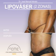 Lipo vaser - Centro CEME