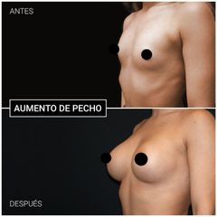 Aumento de pecho - Centro CEME
