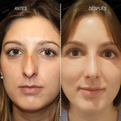 Rinoplastia - Centro CEME