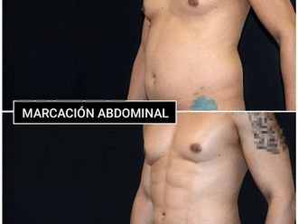 Marcación abdominal - 810924