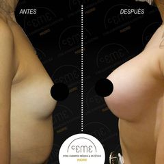 Aumento de pecho - Centro CEME