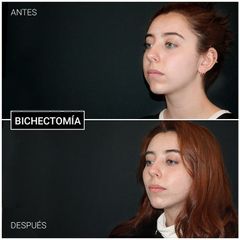 Bichectomía - Centro CEME
