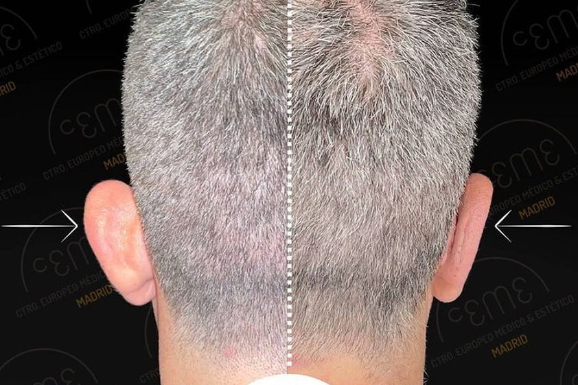 Otoplastia antes y después - 810933