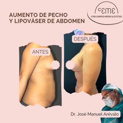 Aumento de pecho y lipováser de abdomen - Centro CEME