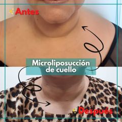 Microliposucción de cuello - Clínica de la Cuesta CDC