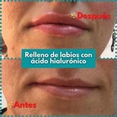 Aumento de labios - Clínica de la Cuesta CDC