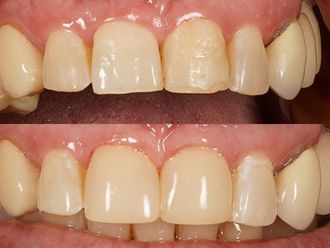 Implantes dentales antes y después - 867922