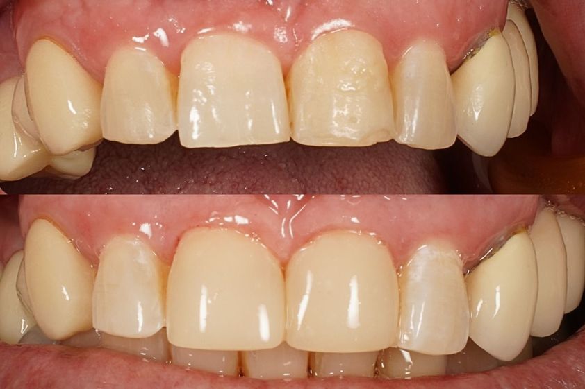 Implantes dentales antes y después - 867922