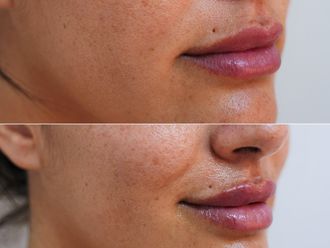 Aumento labios antes y después - 869609