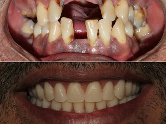 Implantes dentales antes y después - 869610