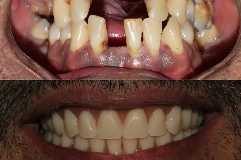 Implantes dentales antes y después - 869610
