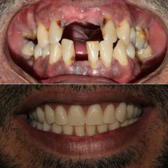 Implantes dentales - Clínica de la Cuesta CDC