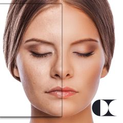 Fotorejuvenecimiento facial - Clínica de la Cuesta CDC