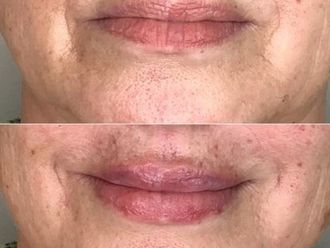 Aumento labios antes y después - 869634