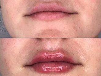 Aumento labios antes y después - 869635