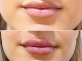 Aumento labios antes y después - 869639