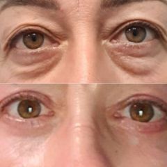 blefaroplastia - clínica de la cuesta CDC