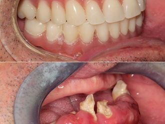 Implantes dentales antes y después - 869652