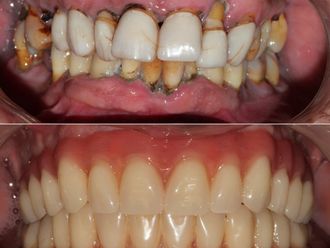 Implantes dentales antes y después - 869658