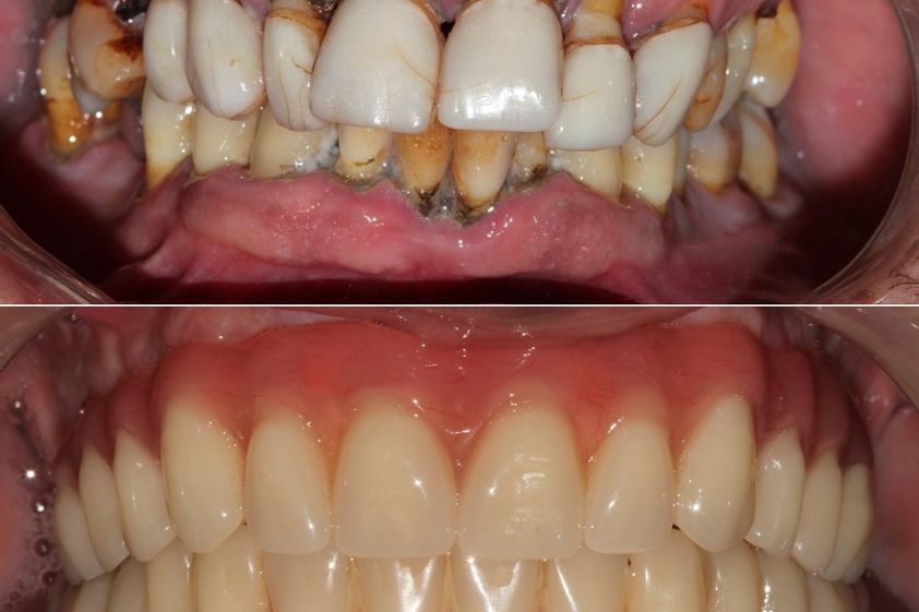 Implantes dentales antes y después - 869658