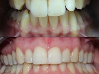 Ortodoncia invisible antes y después - 869659