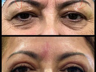 Blefaroplastia antes y después - 870073