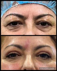 Blefaroplastia - Clínica de la Cuesta - CDC