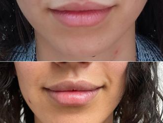 Aumento labios antes y después - 870143