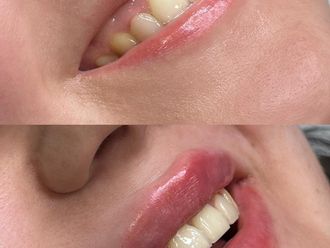 Aumento labios antes y después - 879745