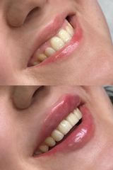 Clínica de la Cuesta CDC - Aumento de labios