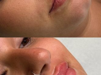 Aumento labios antes y después - 879746