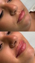 Aumento de labios - Clínica de la Cuesta CDC