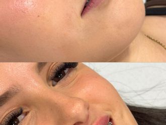 Aumento labios antes y después - 880565
