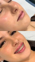 Aumento de labios - Clinica de la Cuesta CDC