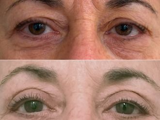 Blefaroplastia antes y después - 873066