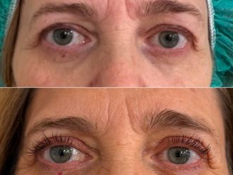 Blefaroplastia antes y después - 873067